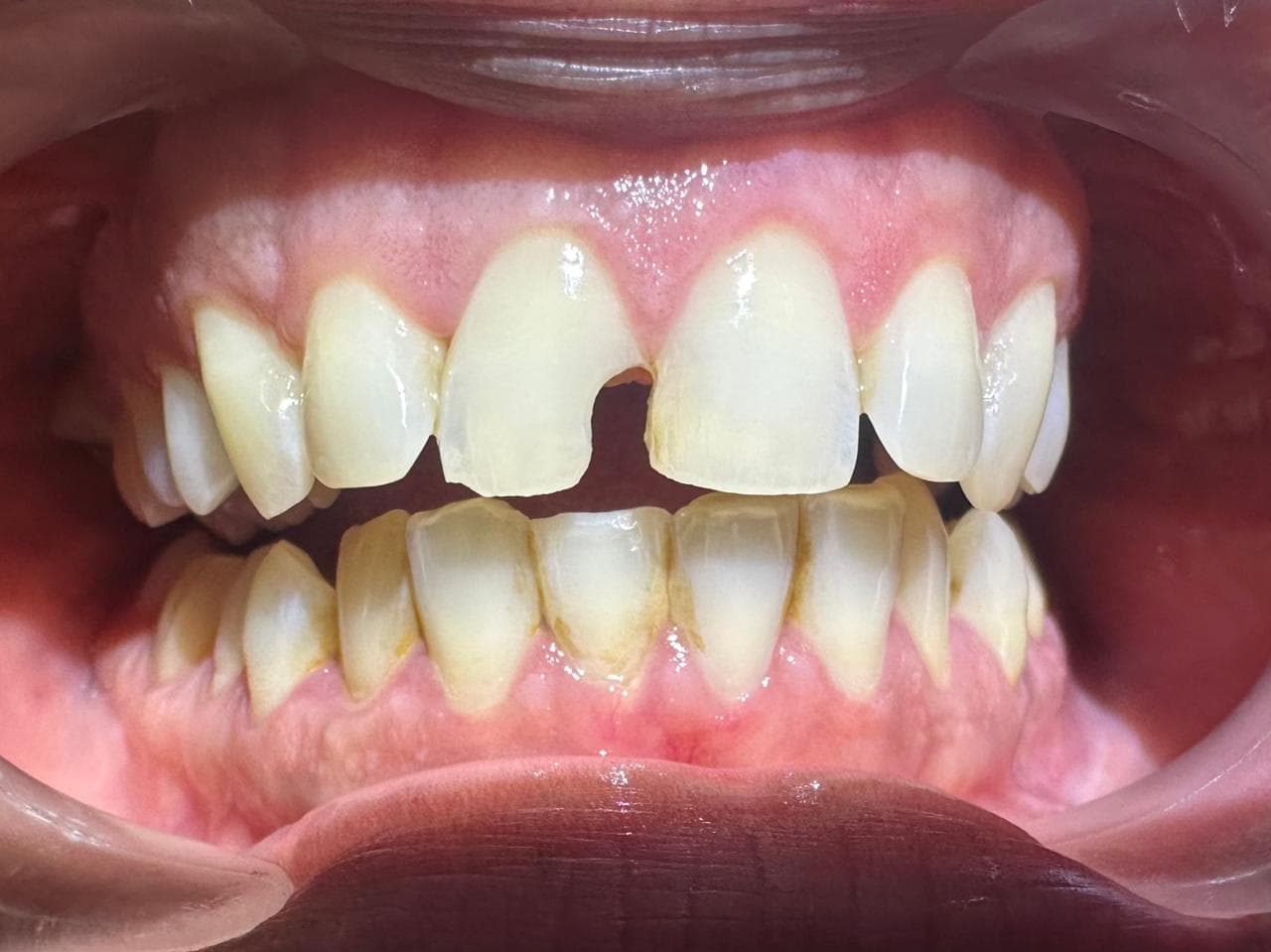 Cosmetic Dentistry - Before